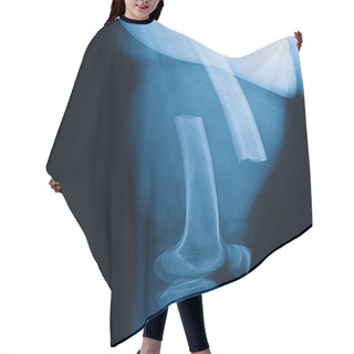 Personality  Broken Human Thigh X-rays Image ,lelf Leg Fracture Hair Cutting Cape