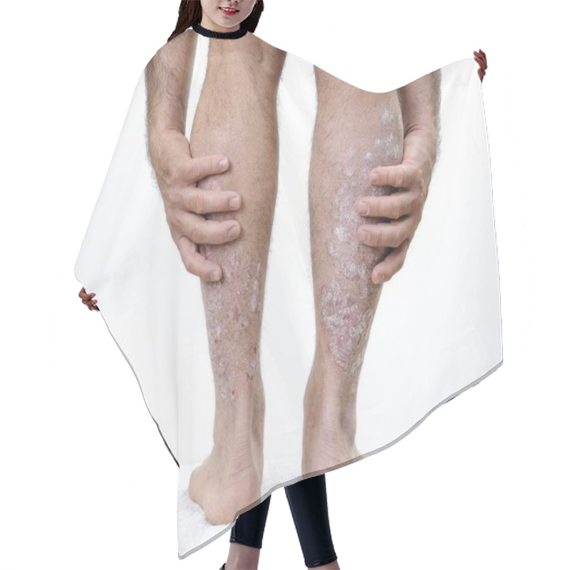Personality  Adult Caucasian Man Suffering From Psoriasis In The Legs Hair Cutting Cape
