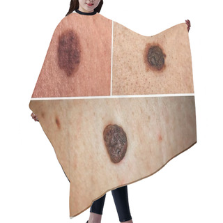 Personality  Photo Collage Of Different Moles On Human Skin. Hair Cutting Cape