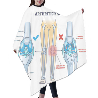 Personality  Arthritic Knee Or Osteoarthritis And Healthy Bones Comparison Outline Diagram. Labeled Educational Scheme With Damaged Cartilage And Bone Spurs Diagnosis Vector Illustration. Anatomical Skeletal Leg. Hair Cutting Cape
