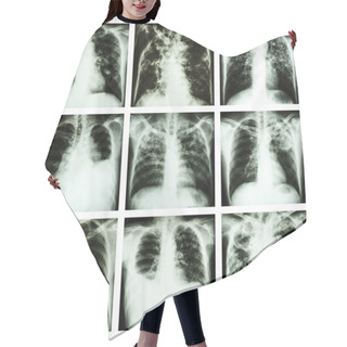 Personality  Collection Of Lung Disease (Pulmonary Tuberculosis,Pleural Effusion,Bronchiectasis) Hair Cutting Cape