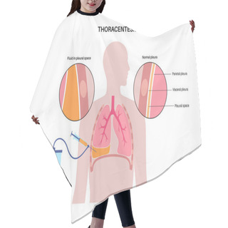Personality  Thoracentesis Procedure Medical Poster. Obtain Fluid From Space Around The Compressed Lung. Incision Of The Chest Wall. Unhealthy Internal Organs, Respiratory System Disease Flat Vector Illustration Hair Cutting Cape