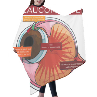 Personality  Information About Glaucoma And Its Evolution In The Eye, Vector Illustration Hair Cutting Cape