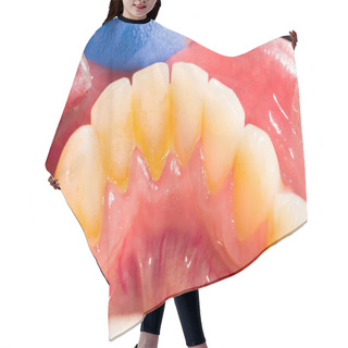 Personality  Dental Plaque In Human Mouth Hair Cutting Cape