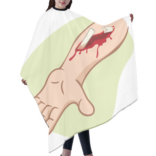 Personality  Illustration Of A Human Arm With A Compound Fracture Showing The Broken Bone. Ideal For Catalogs, Newsletters And First Aid Guides Hair Cutting Cape