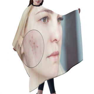 Personality  Young Woman With Acne Skin And Magnifying Glass Hair Cutting Cape