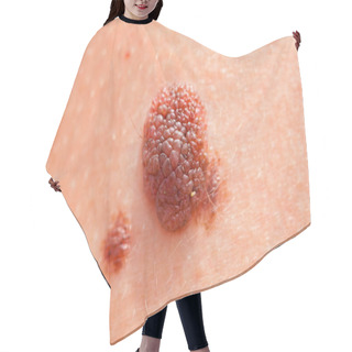 Personality  Brown Nevus On Human Skin Hair Cutting Cape