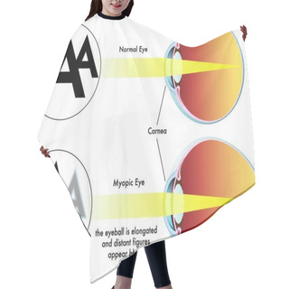 Personality  Medical Illustration Of The Symptoms Of Myopia Hair Cutting Cape