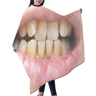 Personality  Teeth With A Lot Of Tartar And Plaque. Concept Of Unhealthy Dirty Teeth. Smokers Teeth. Hair Cutting Cape