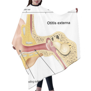 Personality  Otitis Externa Ear Disease 3d Medical Vector Illustration On White Background Hair Cutting Cape