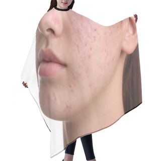 Personality  Teenage Girl With Acne Problem On White Background, Closeup Hair Cutting Cape