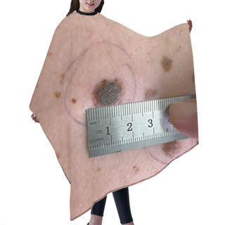 Personality  Measuring The Size Of A Mole On Human Skin. Hair Cutting Cape