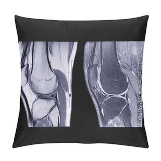 Personality  Magnetic Resonance Imaging Or MRI Knee Comparison Sagittal PDW And TIW View For Detect Tear Or Sprain Of The Anterior Cruciate  Ligament (ACL).clipping Path. Pillow Covers