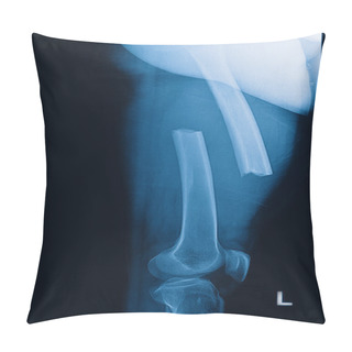 Personality  Broken Human Thigh X-rays Image ,lelf Leg Fracture Pillow Covers
