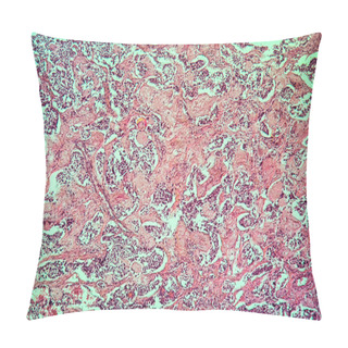 Personality  Thyroid Scirrhous Carcinoma Diseased Tissue 100x Pillow Covers