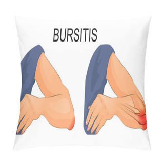 Personality  Bursitis Of The Elbow Joint Pillow Covers