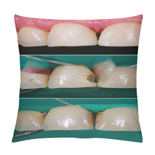 Personality  High-end Nanohybrid Dental Filling Pillow Covers
