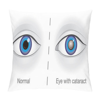 Personality  Normal Eye And Lens Clouded By Cataract. Pillow Covers