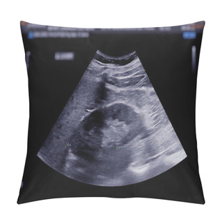 Personality  Ultrasound Upper Abdomen Showing  Kidney. Pillow Covers