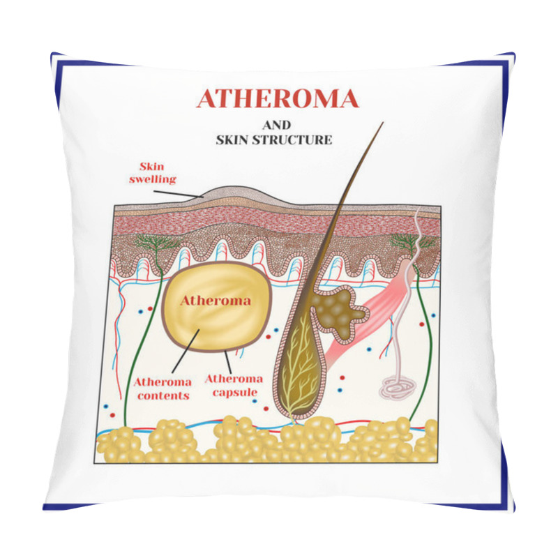 Personality  Atheroma. Cysts, Tumors. Pillow Covers