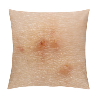 Personality  Close Up Of Molluscum Contagiosum Also Called Water Wart Pillow Covers