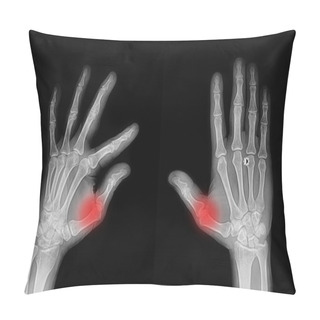 Personality  X-ray Hand And Finger Pillow Covers