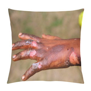 Personality  Burning Injuries On Hand Pillow Covers