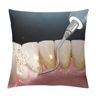 Personality  Oral Hygiene: Ultrasonic Teeth Cleaning Machine Removing Calculus And Plaque. Medically Accurate 3D Illustration Of Human Teeth Treatment Pillow Covers