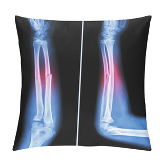 Personality  Fracture Shaft Of Ulnar Bone ( Forearm Bone )  :  ( Front And Side View ) Pillow Covers