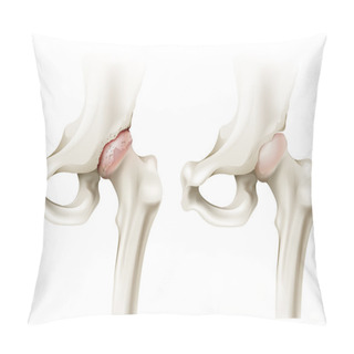 Personality  Hip Arthritis Pillow Covers