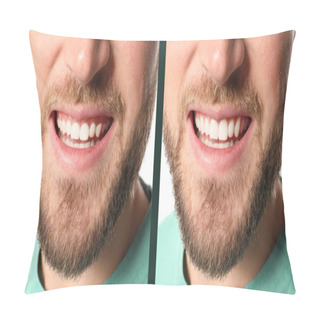 Personality  Young Man Before And After Gingivoplasty Procedure, Closeup. Banner Design Pillow Covers