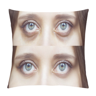 Personality  Female Green Eyes With Bruises Under Eyes Before And After Cosmetic Treatment Pillow Covers