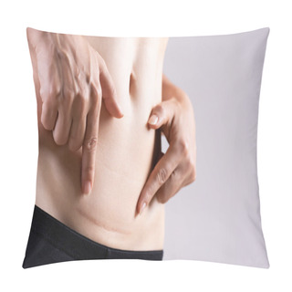 Personality  Closeup Of Woman Showing On Her Belly Dark Scar From A Cesarean Section. Healthcare Concept. Pillow Covers
