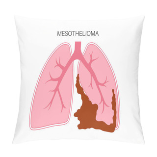 Personality  Mesothelioma Tumor Cells Poster. Lung Cancer Concept. Respiratory System Illness. Asbestos Related Diseases. Shortness Of Breath, Pain In Chest, Breathing Problem, Medical Flat Vector Illustration. Pillow Covers