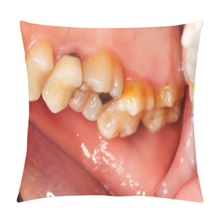 Personality  Dental Problems Pillow Covers