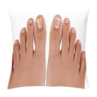 Personality  Onychomycosis And Fungal Nail Infection Or Tinea Unguium As An Infected Foot Toenail Or Toe Nail With Damaged Unhealthy And Healthy Human Anatomy In A 3D Illustration Style. Pillow Covers