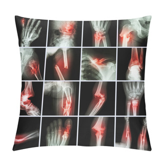 Personality  Collection X-ray Multiple Bone Fracture (finger,spine,wrist,hip,leg,clavicle,ankle,elbow,arm,foot) Pillow Covers