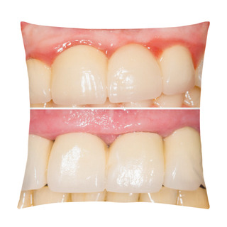 Personality  Buffing Teeth Tangent And With Shoulder Pillow Covers