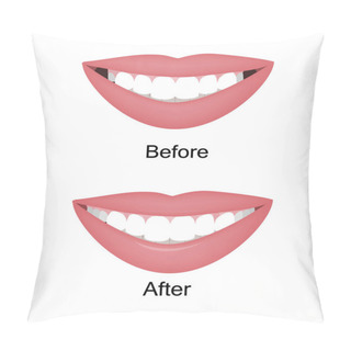 Personality  The Smile With Large And Dark Buccal Corridor Before And After Correction. Vector Illustration. Dark Spaces At The Edge Of The Smile Problem Treatment Pillow Covers