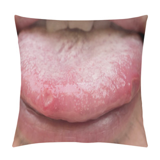 Personality  Tongue With Ulcers Of Adult Man Pillow Covers