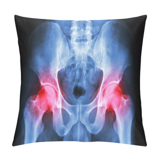 Personality  Film X-ray Human's Pelvis And Arthritis At Both Hip Joint (Gout , Rheumatoid) Pillow Covers