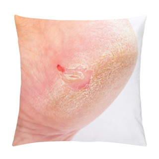 Personality  Dry Skin On Heel Pillow Covers