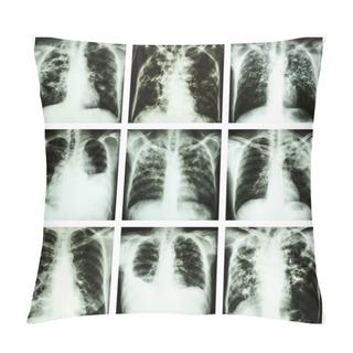 Personality  Collection Of Lung Disease (Pulmonary Tuberculosis,Pleural Effusion,Bronchiectasis) Pillow Covers