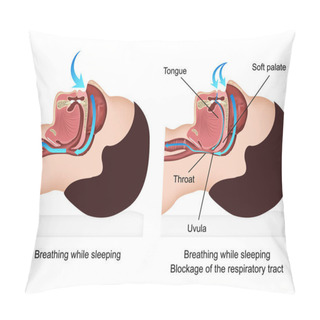 Personality  Snoring Medical Vector Illustration With Description On White Background Pillow Covers