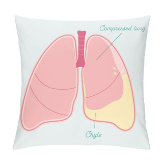 Personality  Chylothorax In Human Lung. Accumulation Of Lymph In Pleural Space - Vector Anatomical Scheme Pillow Covers