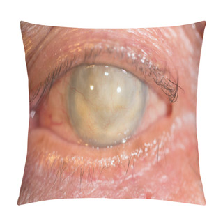 Personality  Phthisis Bulbi At Eye Test Pillow Covers
