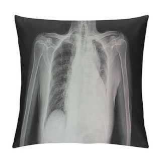 Personality  A Chest X-ray Film  Of A Patient With Cardiomegaly With Left Side Heart Failure, Pulmonary Edema, And Pericadial Effusion Pillow Covers