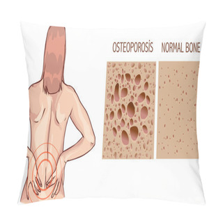 Personality  Osteoporosis, Human Bone Anatomy. Medical Illustration Healthy B Pillow Covers