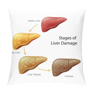 Personality  Stages Of Liver Damage. Liver Disease. Healthy, Fatty, Fibrosis And Cirrhosis. Illustration Info-graphic, Isolated On White Background. Pillow Covers