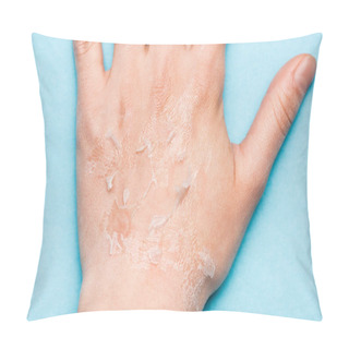 Personality  Partial View Of Female Hand With Dry, Exfoliated Skin On Blue Pillow Covers